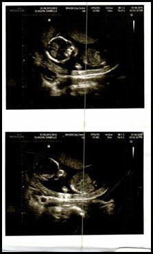 baby 3 ultrasound 13 weeks